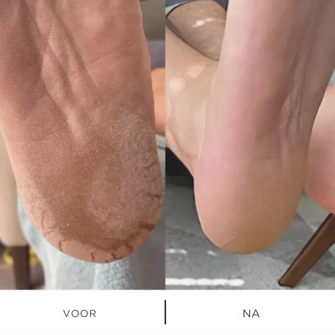 SoftStep Eeltverwijderaar
